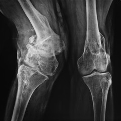 radiografia di ginocchia patologiche - obrazy, fototapety, plakaty