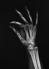 radiografia della mano