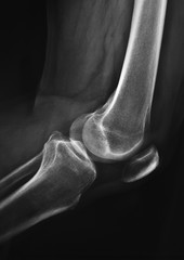 radiografia del ginocchio