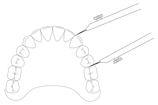 Korkhaus calipers