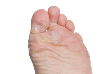 Callus on toes