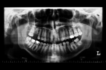 menschlicher Kiefer, Panoramaaufnahme mittels Röntgen