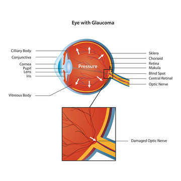 Eye With Glaucoma Eps10 Vector Illustration