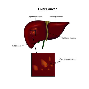 liver cancer vector illustration