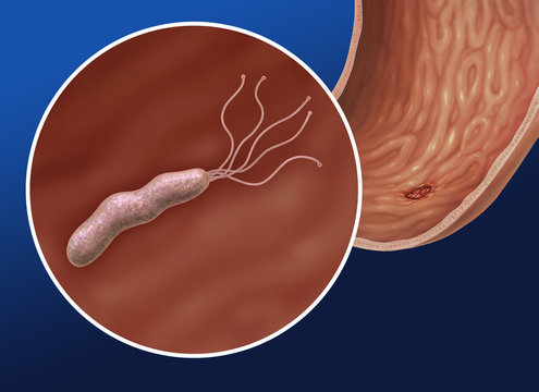 Helicobacter pylori
