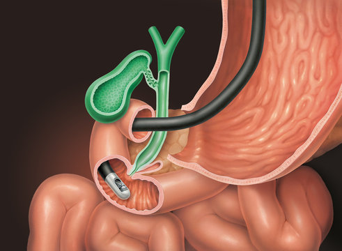 Magen, Duodenoskop und Gallenblase