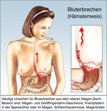 Blut-Erbrechen, Brechreiz, Uebelkeit