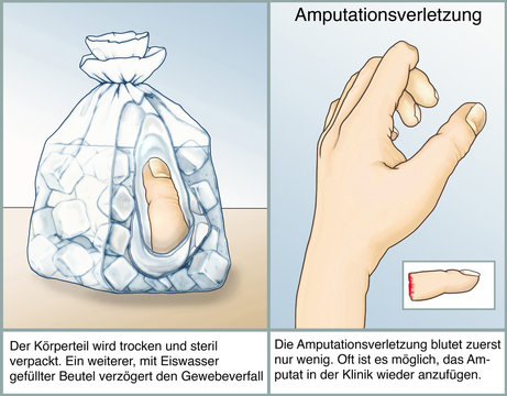 Amputationsverletzung.Erste Hilfe