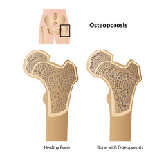 osteoporosis medical vector illustration