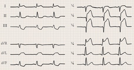 acute myocardial infarction with Q wave. ECG.detailed vector