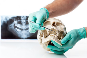 Dentist showing dental caries in a human skull.