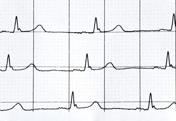 heart rate in graph on a paper from the medical device