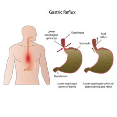 Gastroesophageal reflux disease medical vector illustration