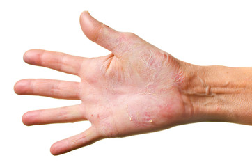 Eczema on a hand
