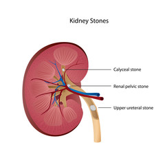 kidney stones medical vector illustration english