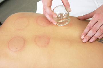 cupping spa treatment