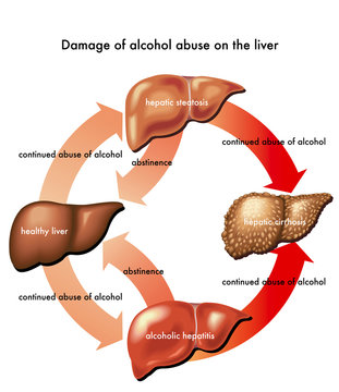 fegato e alcool