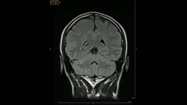 IRM, imagerie r&eacute;sonance magn&eacute;tique
