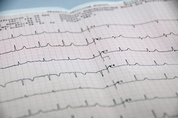 EKG-Kurve