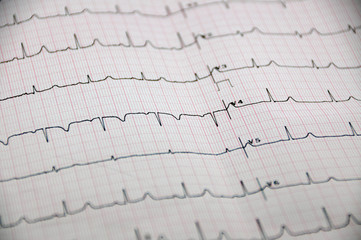 EKG-Kurve