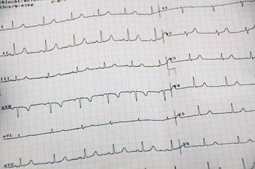 EKG-Kurve