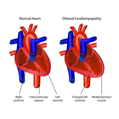 dilated cardiomyopathy heart vector illustration