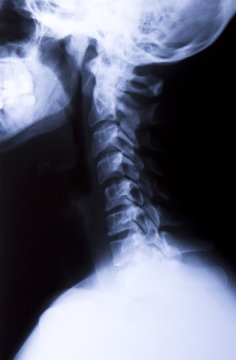 Side Neck X-Ray