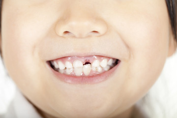 歯がない女の子