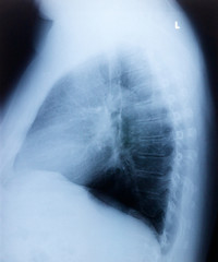 Röntgenbild Schulter