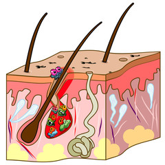 Scheme of skin with acne