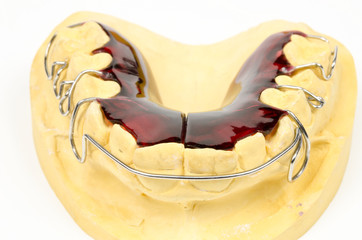 tiefrote Dehnplatte frontal mit  Modell (Kieferorthopädie) © Michael Tieck