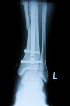 Röntgnbild Fraktur Schien- und Wadenbein mit Stabilisierung