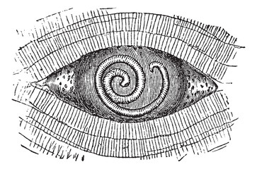 Pork Roundworm or Trichinella spiralis, vintage engraving