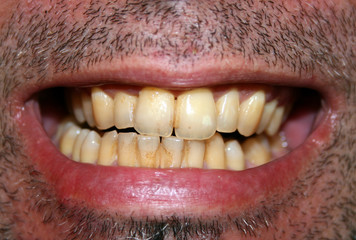 Obraz premium Yellow teeth