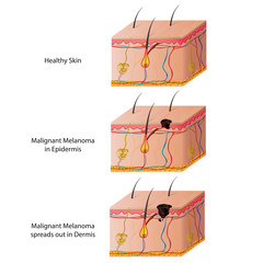 skin cancer malignant melanoma vector illustration