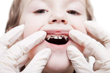 Examining caries teeth decay
