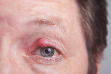 Auge mit Gerstenkorn