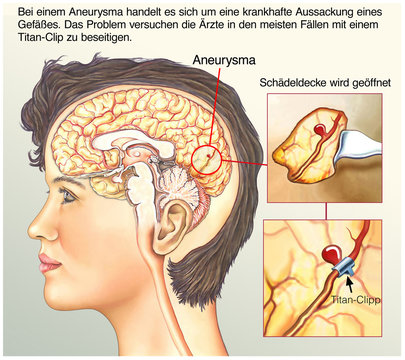 Aneurysma.Titan-Clipp.Gehirn-OP