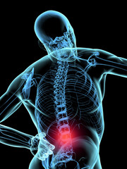 Rückenschmerzen Rheuma - obrazy, fototapety, plakaty