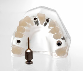 dental implants3