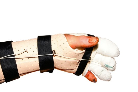 Fingerverletzung