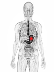 Obraz premium 3d rendered scientific illustration of a stomach tumor