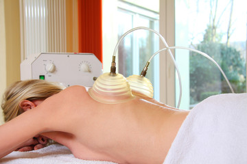 Schröpfmassage am Rücken