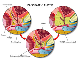 Cancro della prostata