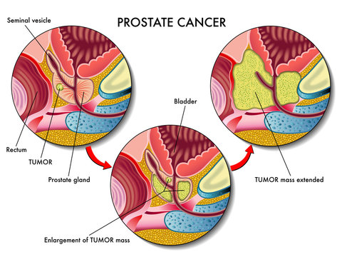 Cancro della prostata