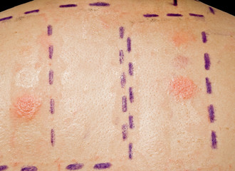 Skin Allergy Patch Test Showing Positive Reaction