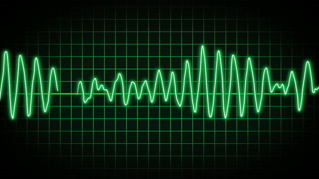 EKG Screen