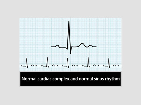 Normal Cardiac Complex And  Normal Sinus Rhythm