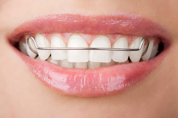 teeth with retainer - obrazy, fototapety, plakaty