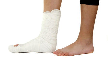 leg in a plaster cast